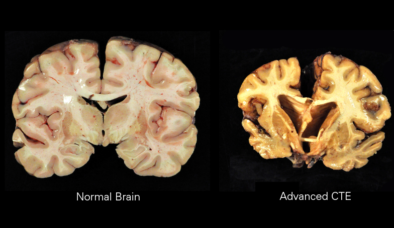 Photo via Wikipedia (Chronic traumatic encephalopathy)