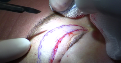 Photo via Wikipedia (Blepharoplasty)
